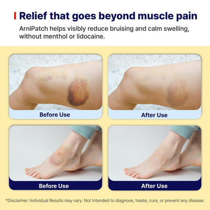 Arnica Hydrogel Pain Relief Patches | Natural Relief for Muscle, Joint, Bruises & Swelling | Flexible, Non-Greasy & Long-Lasting | Great for Back, Knee & Neck Pain (3.9"x4.7", 10, Count) Wooshin LabottachBuy Supplements Australia