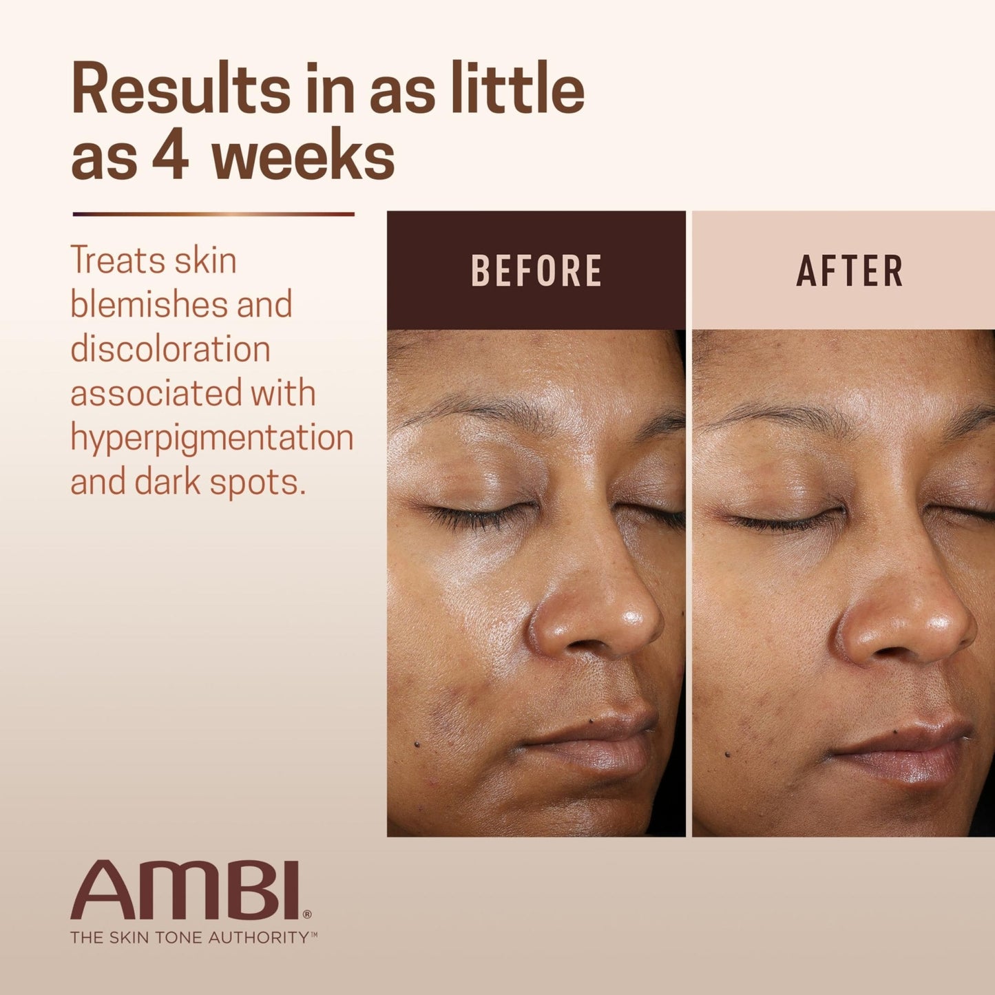 Ambi Even & Clear Advanced Fade Cream, Hydroquinone-free, Hyperpigmentation Treatment, Stubborn Dark Spot Corrector, Results In As Little As 2-3 Weeks - Maple Wellness Supplements