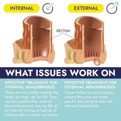 Hemorrhoid Treatment | Hemorrhoid Ointment | Hemorrhoid & Fissure Ointment | 7 Pre-Filled Applicators | Fast & Effective Relief | Reduces Swelling, Itching & Discomfort | Advanced Formula - Maple Wellness Supplements