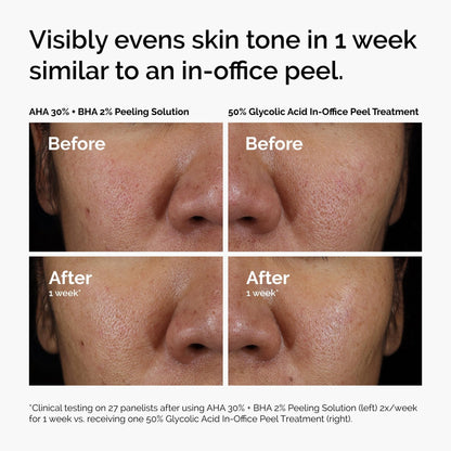 The Ordinary AHA 30% + BHA 2% Peeling Solution, Advanced Exfoliating Peel for Brighter Skin, 1 Fl Oz - Maple Wellness Supplements